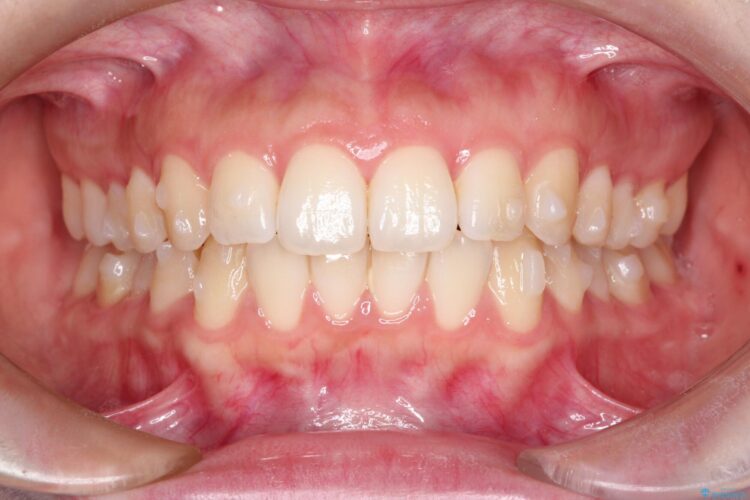 前歯のがたつき　インビザラインで目立たない矯正 治療途中画像