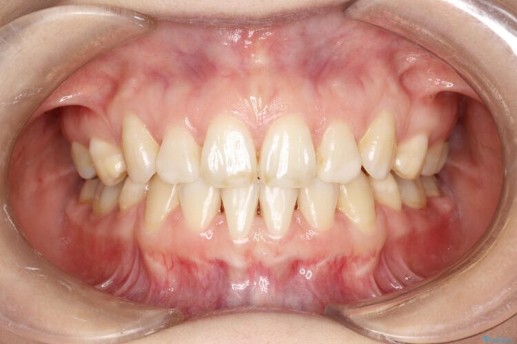 歯が前に出てて、口が閉じない　抜歯矯正による口元の改善 治療後画像