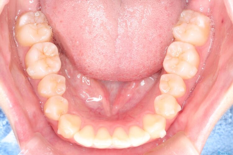 前歯のがたつき　インビザラインで目立たない矯正 治療途中画像