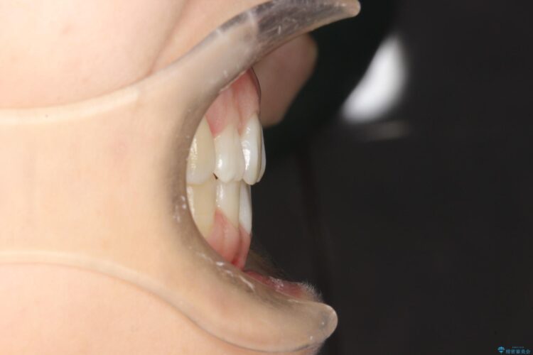 歯が前に出てて、口が閉じない　抜歯矯正による口元の改善 治療後画像