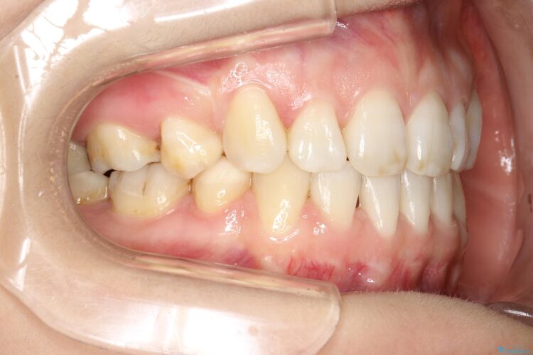 歯が前に出てて、口が閉じない　抜歯矯正による口元の改善 アフター