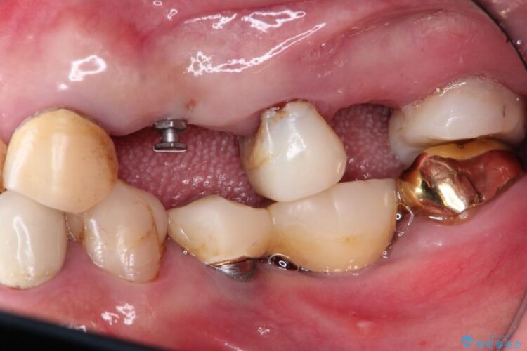 部分矯正で歯を正しい位置に移動しインプラント治療を行った症例 ビフォー