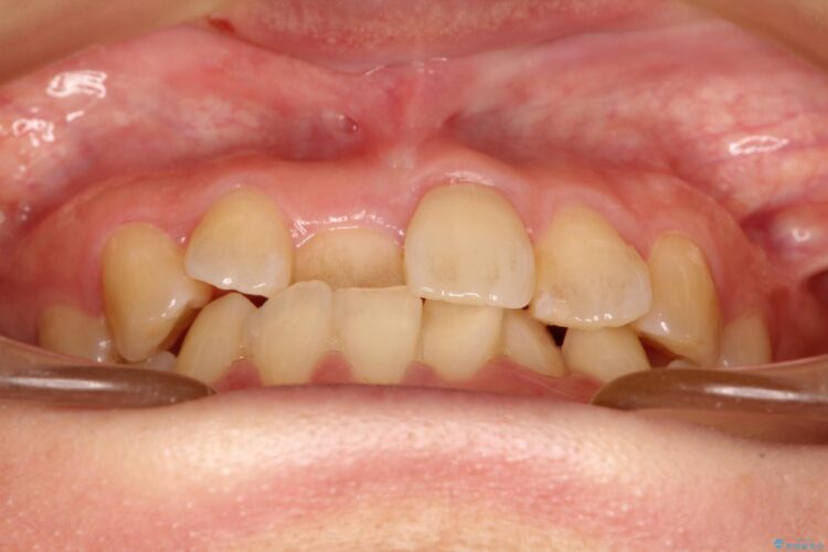インビザラインにて矯正　その後に前歯のセラミッククラウン治療 治療前画像