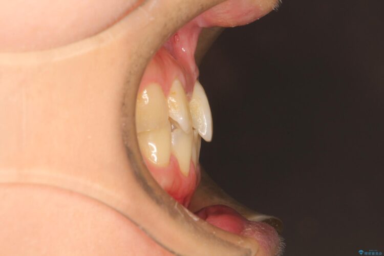 インビザラインにて矯正　その後に前歯のセラミッククラウン治療 治療前画像