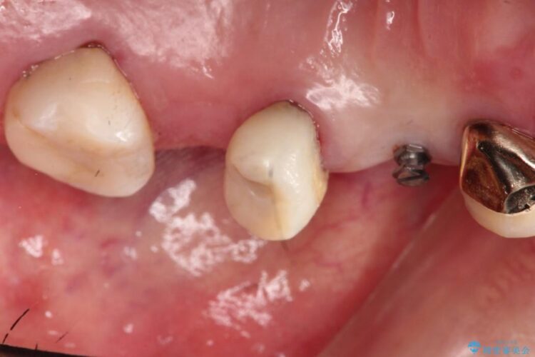 部分矯正で歯を正しい位置に移動しインプラント治療を行った症例 治療前画像