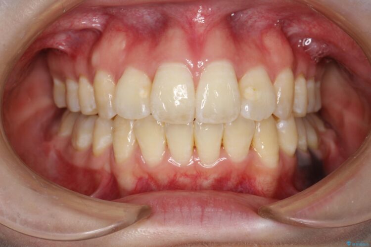 重度のガタガタ　ワイヤーによる抜歯矯正 治療後画像