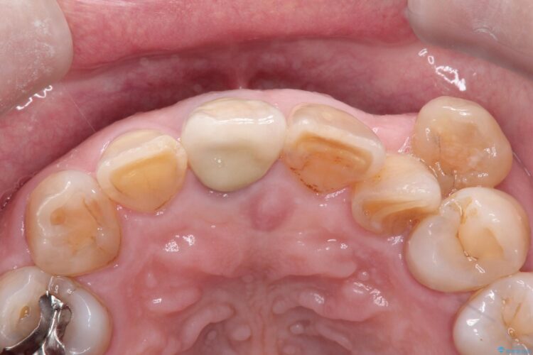 セラミックによる前歯の変色の改善 治療後画像