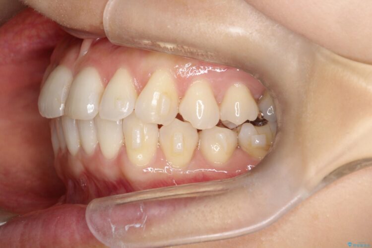 八重歯と前歯のガタガタをインビザラインで 治療途中画像