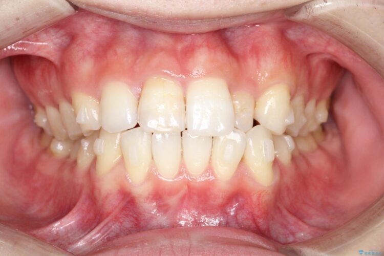 インビザラインとセラミック治療　理想的な歯並びへ 治療途中画像