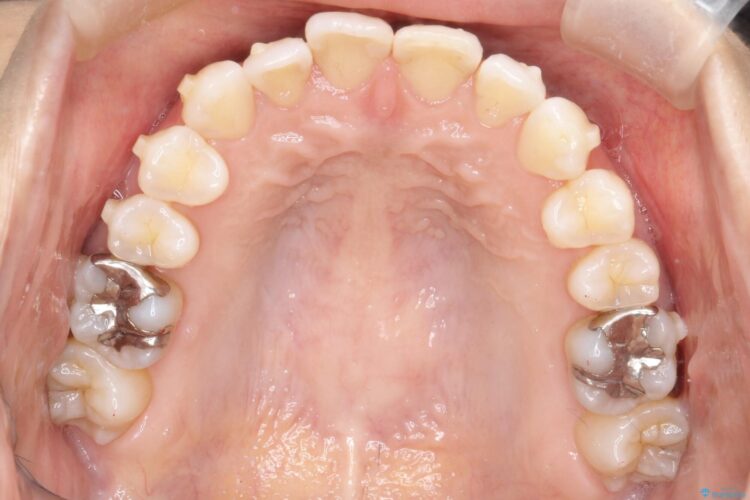 八重歯と前歯のガタガタをインビザラインで 治療途中画像