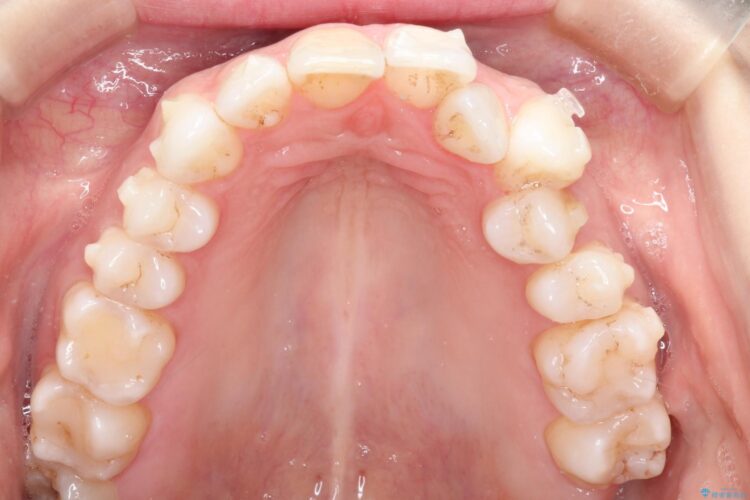 インビザラインによる非抜歯での八重歯の矯正 治療途中画像