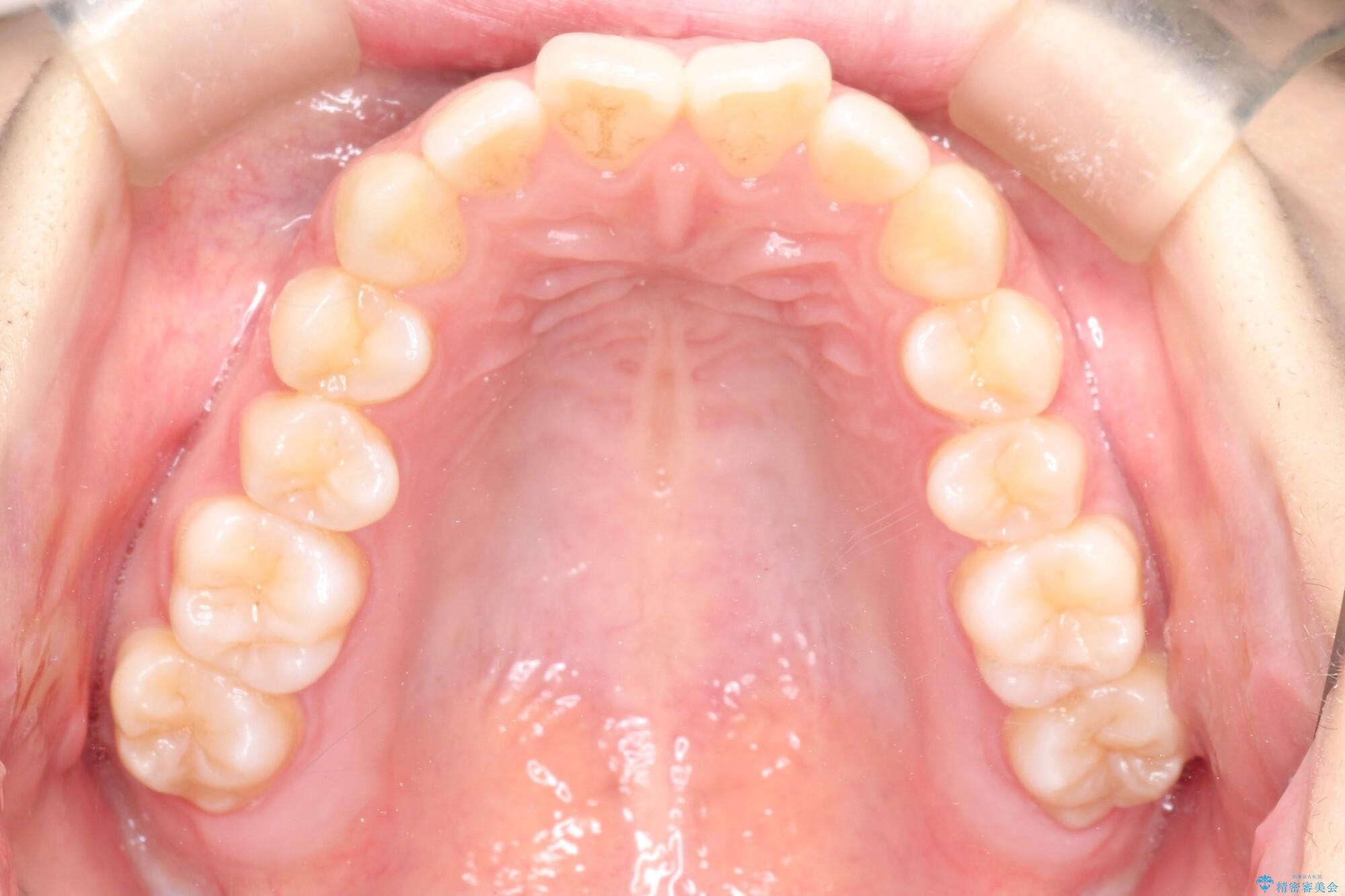 前歯のがたつき　インビザラインで目立たない矯正 治療前