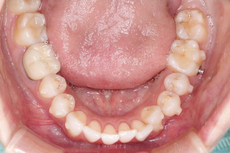 インビザラインによる非抜歯での八重歯の矯正 治療途中画像