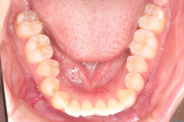 前歯のがたつき　インビザラインで目立たない矯正 治療前画像