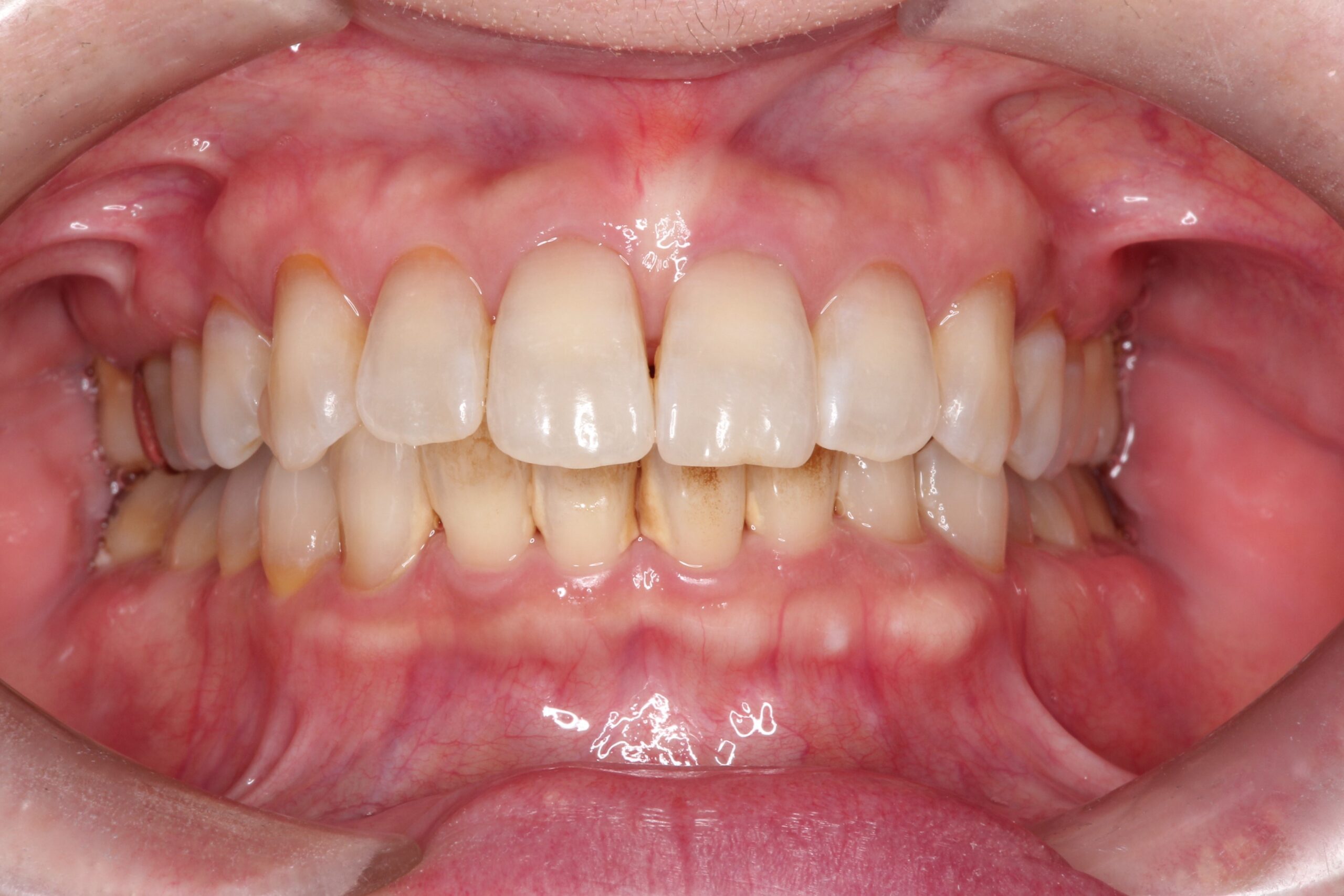 PMTCで歯本来の白さへ 治療前