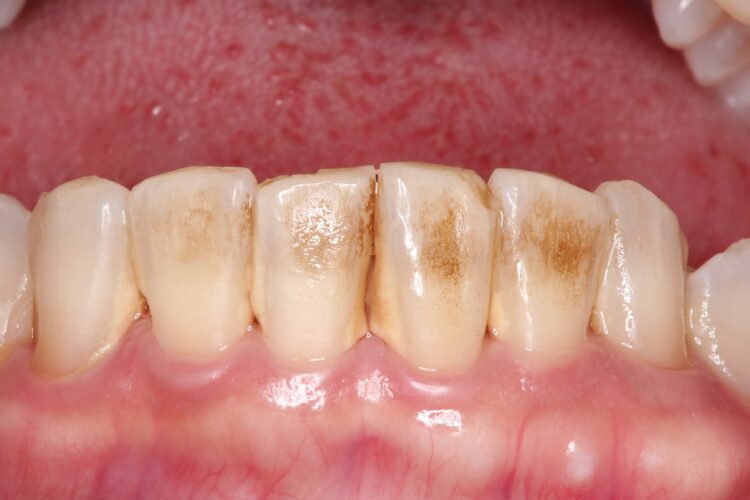 PMTCで歯本来の白さへ 治療前画像