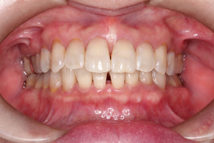 PMTCで歯本来の白さへ 治療後画像