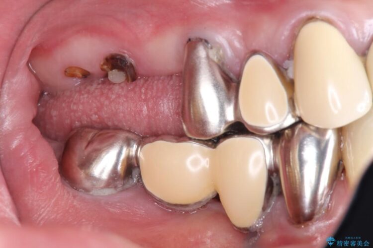 奥歯で咬むことができない　インプラントとセラミックによる咬み合わせの回復 ビフォー