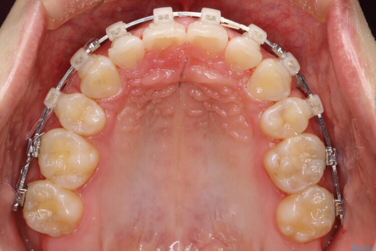 出っ歯の矯正　抜歯をしてしっかり引っ込めるワイヤー矯正 治療途中画像
