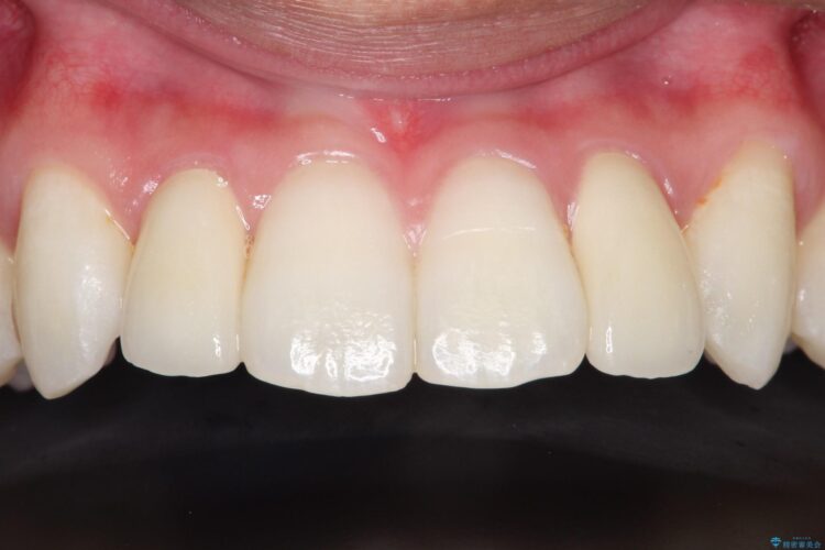 矮小歯(通常より小さな歯)をオールセラミックへ　自然な見た目に 治療後画像