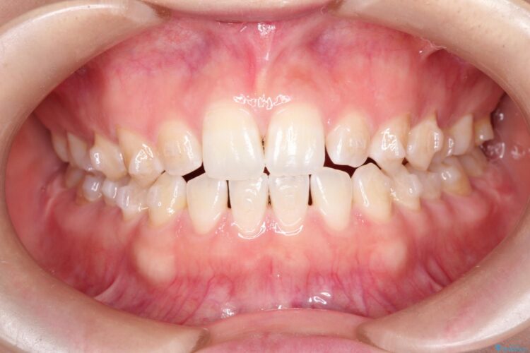 前歯の隙間を閉じたい　インビザラインによる矯正 治療途中画像