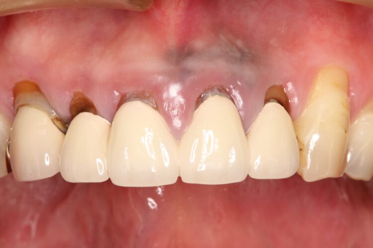 上の前歯の根元が黒い　根の治療をしてからセラミックの再治療 治療前画像