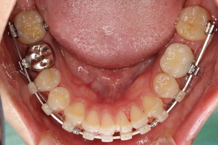 出っ歯の矯正　抜歯をしてしっかり引っ込めるワイヤー矯正 治療途中画像