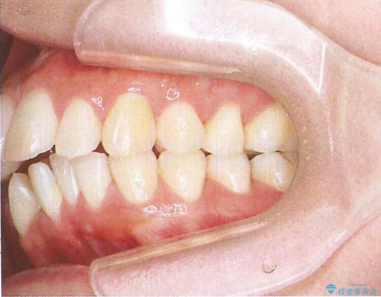 裏側装置で出っ歯の矯正治療 治療前画像
