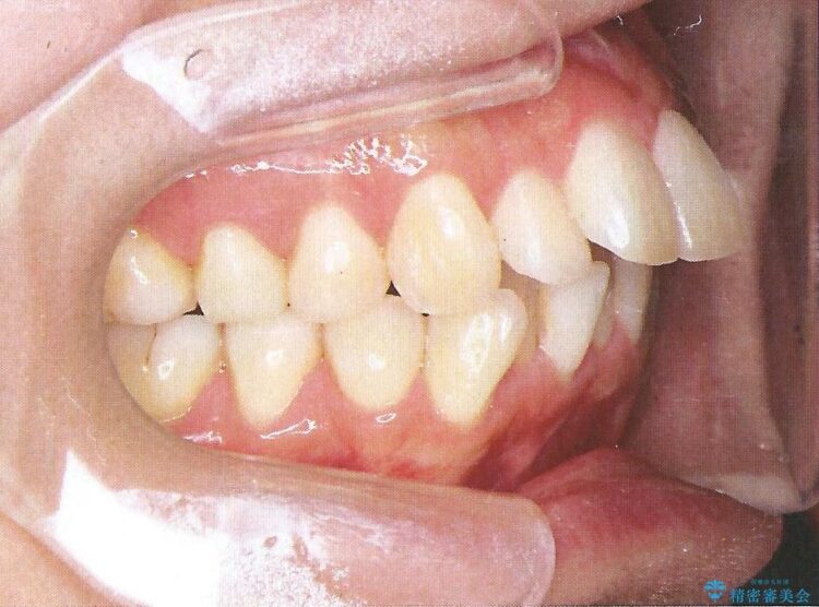 裏側装置で出っ歯の矯正治療 治療前画像
