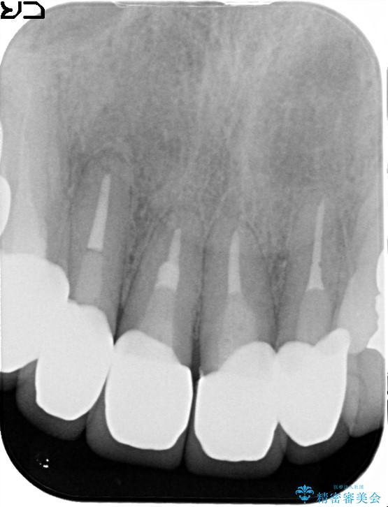 上の前歯の根元が黒い　根の治療を含めたセラミック再治療 治療後画像