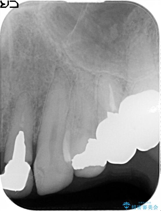 上の前歯の根元が黒い　根の治療を含めたセラミック再治療 治療前画像