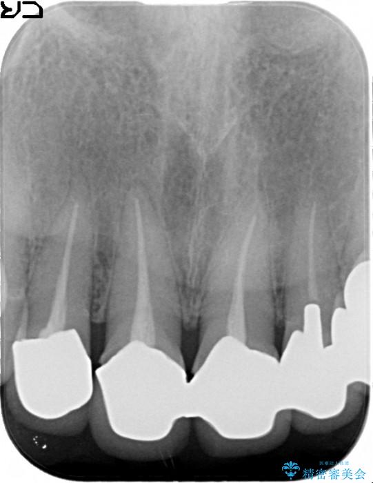 歯の根元が黒いのが気になる　セラミックによる再補綴での改善 治療前画像