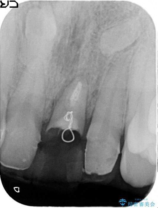 前歯のブリッジ治療　部分矯正を併用して歯茎の形態をコントロール 治療途中画像