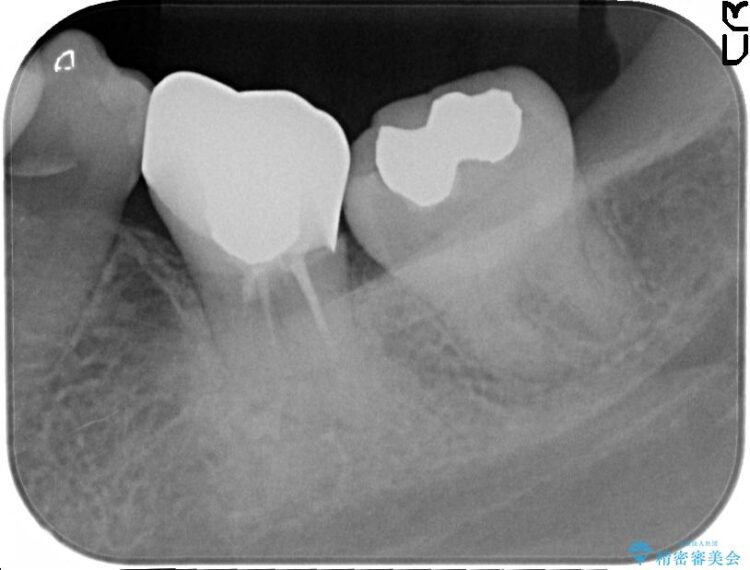 目立つ銀歯を白くしたい　銀歯からセラミックへの再補綴 治療前画像