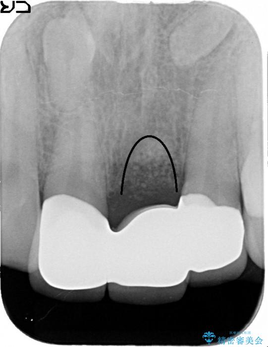 前歯のブリッジ治療　部分矯正を併用して歯茎の形態をコントロール 治療途中画像