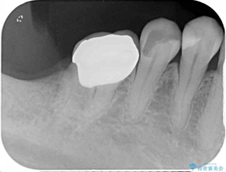 目立つ銀歯を白くしたい　銀歯からセラミックへの再補綴 治療後画像
