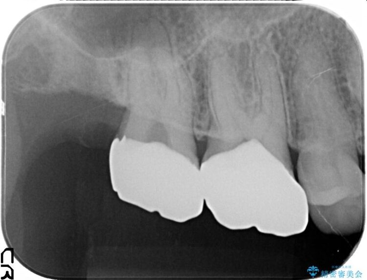 金属の下に虫歯　オールセラミッククラウンによる虫歯治療 治療後画像