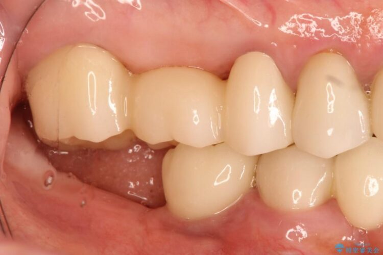 歯周外科の併用の補綴治療　適合の良いセラミックブリッジへ 治療後画像