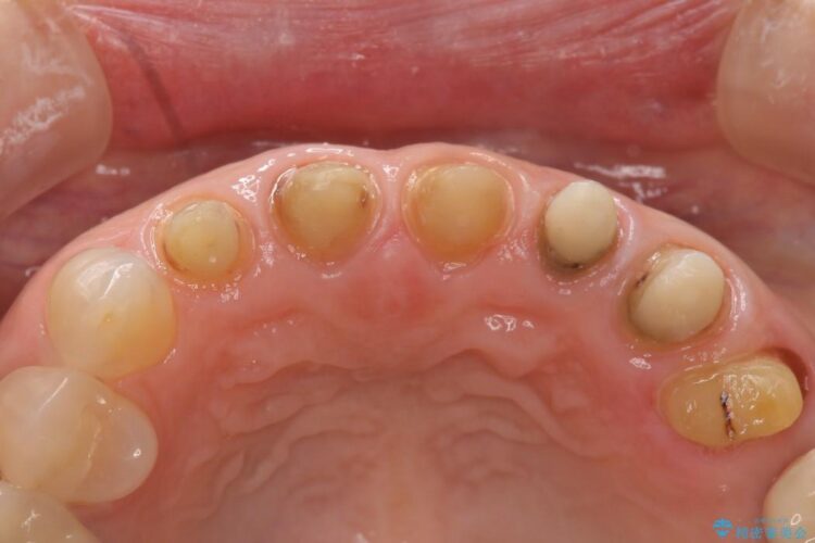 歯の根元が黒いのが気になる　セラミックによる再補綴での改善 治療途中画像