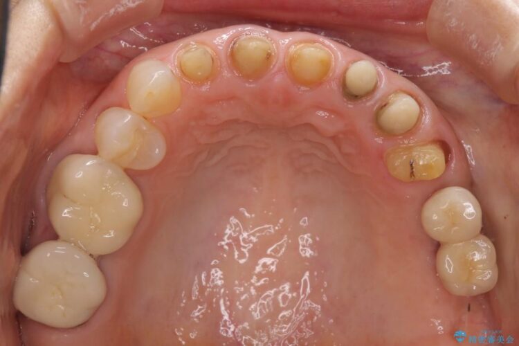 歯の根元が黒いのが気になる　セラミックによる再補綴での改善 治療途中画像
