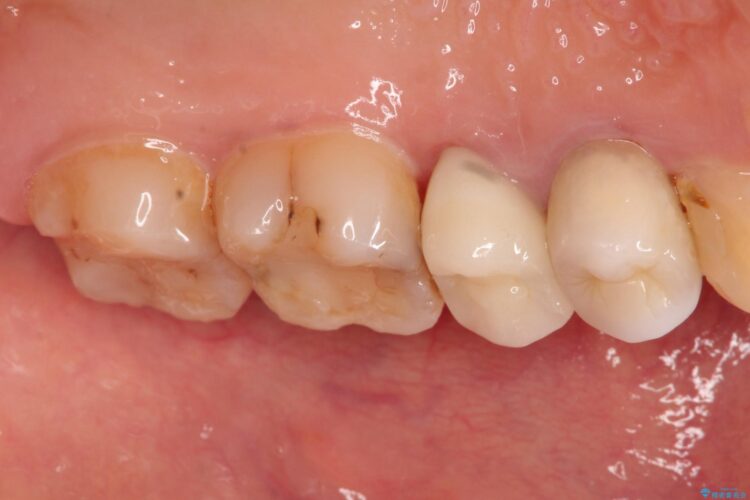歯肉の中までの深い虫歯　部分矯正後のセラミック治療 治療後画像