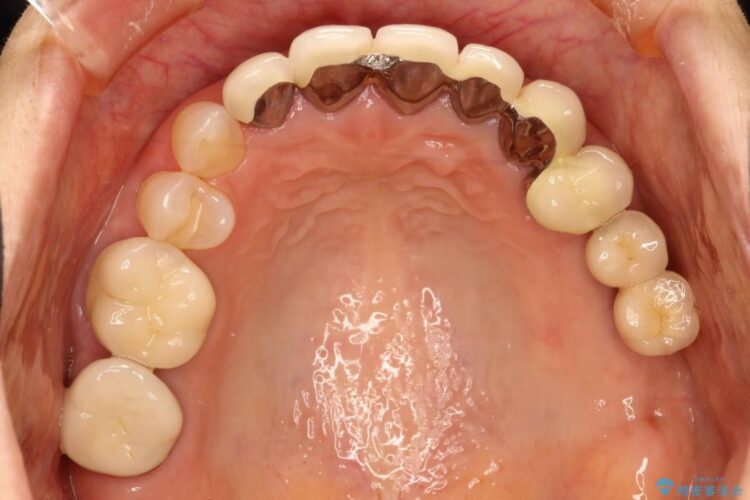 歯の根元が黒いのが気になる　セラミックによる再補綴での改善 治療前画像