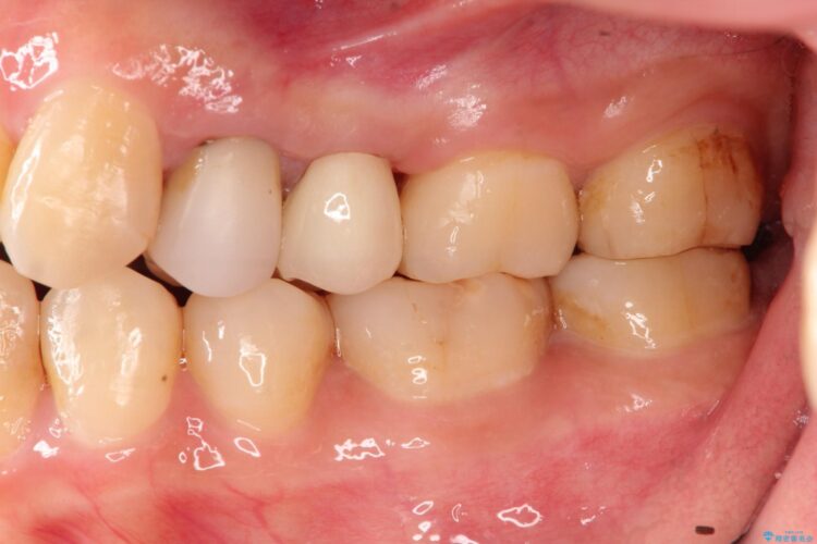 歯肉の中までの深い虫歯　部分矯正後のセラミック治療 アフター