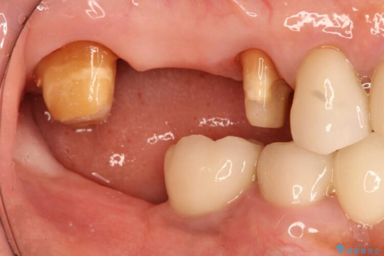 歯周外科の併用の補綴治療　適合の良いセラミックブリッジへ 治療途中画像