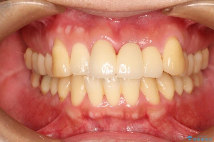 前歯のブリッジ治療　部分矯正を併用して歯茎の形態をコントロール アフター