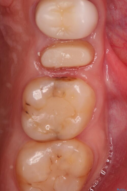 歯肉の中までの深い虫歯　部分矯正後のセラミック治療 治療途中画像