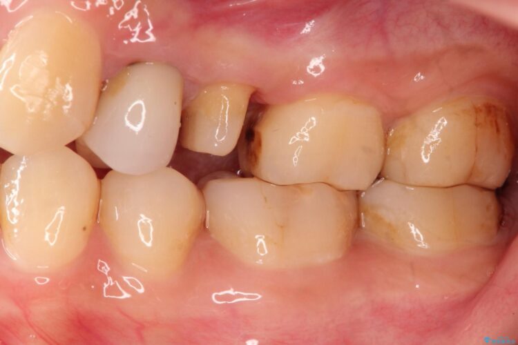 歯肉の中までの深い虫歯　部分矯正後のセラミック治療 治療途中画像