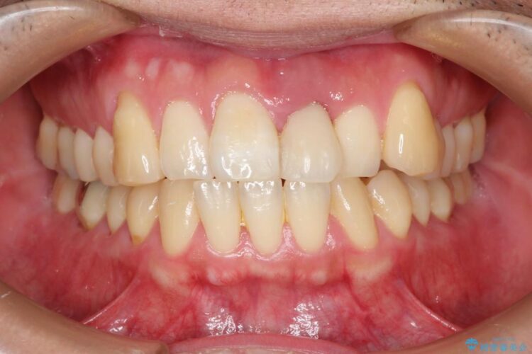 前歯のブリッジ治療　部分矯正を併用して歯茎の形態をコントロール ビフォー