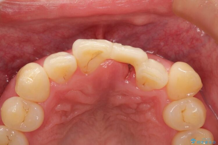 前歯のブリッジ治療　部分矯正を併用して歯茎の形態をコントロール 治療前画像