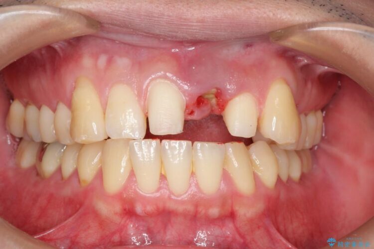 前歯のブリッジ治療　部分矯正を併用して歯茎の形態をコントロール 治療前画像